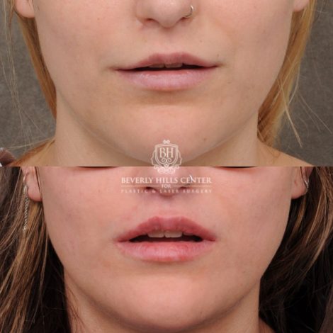 Beverly Hills Center Female Patient Before and After CUPID LIFT® with Chin Revision