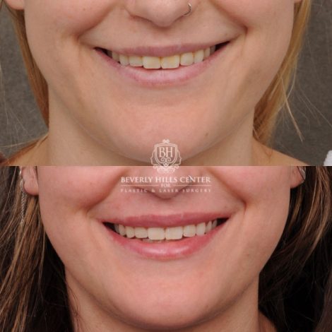 Beverly Hills Center Female Patient Before and After CUPID LIFT® with Chin Revision