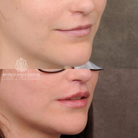 Beverly Hills Center Female Patient Before and After CUPID LIFT® with Chin Revision