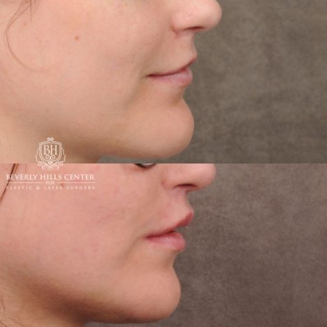 Beverly Hills Center Female Patient Before and After CUPID LIFT® with Chin Revision