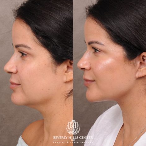 Beverly Hills Center Female Patient Before and After AuraLyft with Minor Fat Grafting to Face