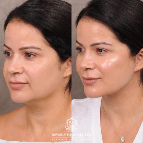 Beverly Hills Center Female Patient Before and After AuraLyft with Minor Fat Grafting to Face