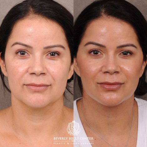 Beverly Hills Center Female Patient Before and After AuraLyft with Minor Fat Grafting to Face