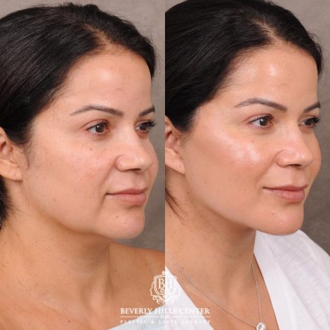 Beverly Hills Center Female Patient Before and After AuraLyft with Minor Fat Grafting to Face