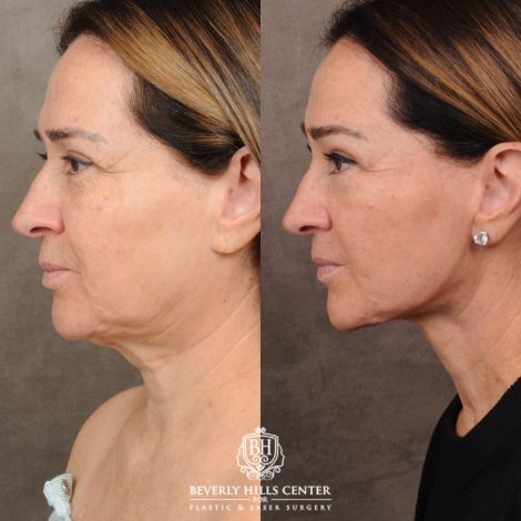 Beverly Hills Center Female Patient Before and After AuraLyft, Brow Lift, CUPID LIFT® Lip Lift, Upper Blepharoplasty