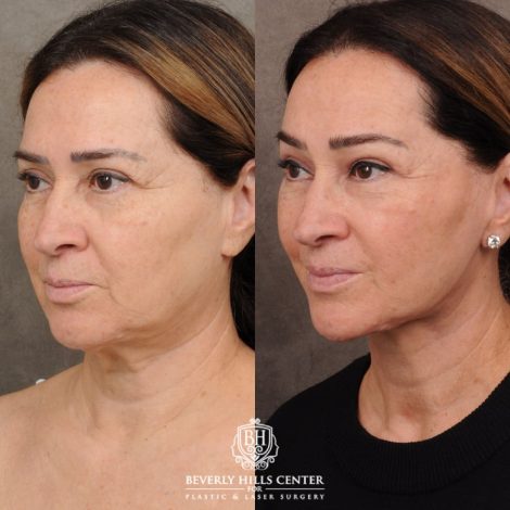 Beverly Hills Center Female Patient Before and After AuraLyft, Brow Lift, CUPID LIFT® Lip Lift, Upper Blepharoplasty