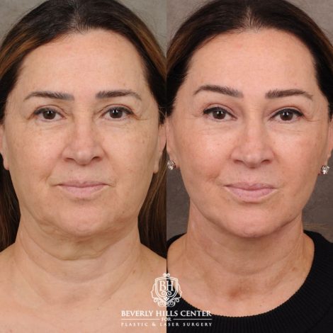 Beverly Hills Center Female Patient Before and After AuraLyft, Brow Lift, CUPID LIFT® Lip Lift, Upper Blepharoplasty