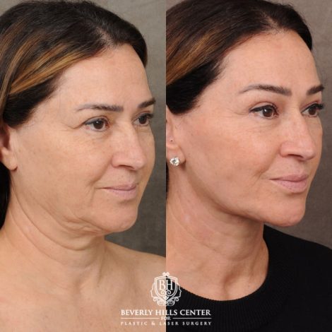 Beverly Hills Center Female Patient Before and After AuraLyft, Brow Lift, CUPID LIFT® Lip Lift, Upper Blepharoplasty