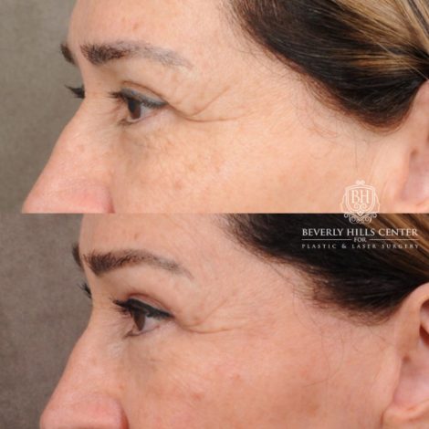 Beverly Hills Center Female Patient Before and After AuraLyft, Brow Lift, CUPID LIFT® Lip Lift, Upper Blepharoplasty