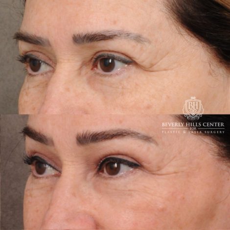 Beverly Hills Center Female Patient Before and After AuraLyft, Brow Lift, CUPID LIFT® Lip Lift, Upper Blepharoplasty