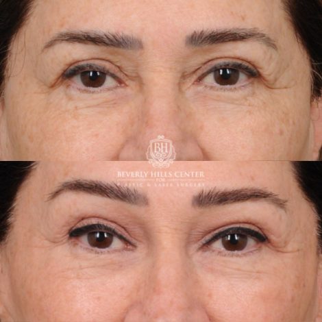 Beverly Hills Center Female Patient Before and After AuraLyft, Brow Lift, CUPID LIFT® Lip Lift, Upper Blepharoplasty
