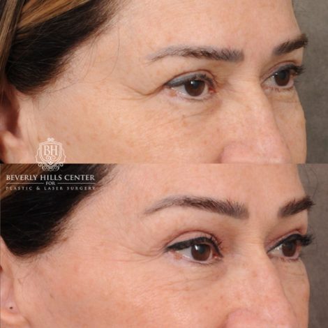 Beverly Hills Center Female Patient Before and After AuraLyft, Brow Lift, CUPID LIFT® Lip Lift, Upper Blepharoplasty