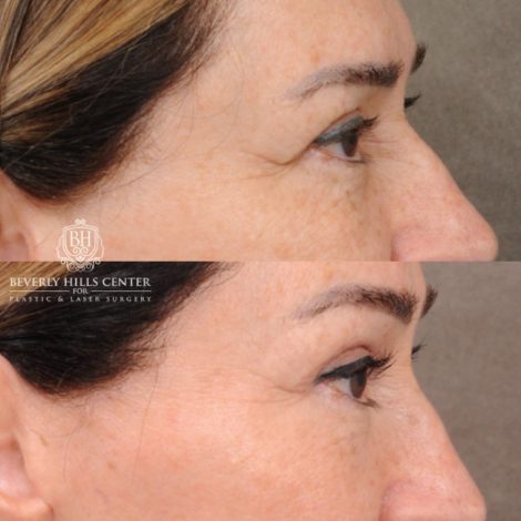 Beverly Hills Center Female Patient Before and After AuraLyft, Brow Lift, CUPID LIFT® Lip Lift, Upper Blepharoplasty