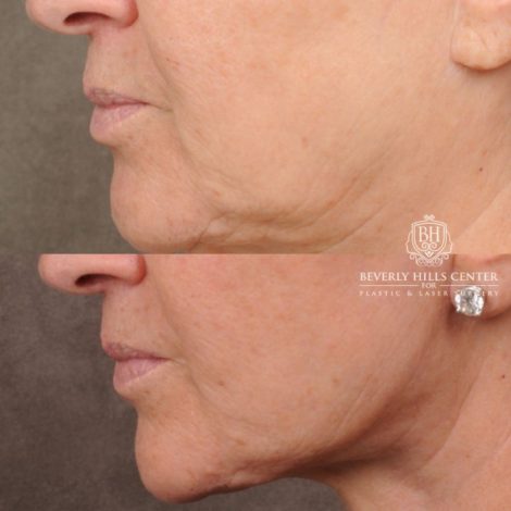 Beverly Hills Center Female Patient Before and After AuraLyft, Brow Lift, CUPID LIFT® Lip Lift, Upper Blepharoplasty