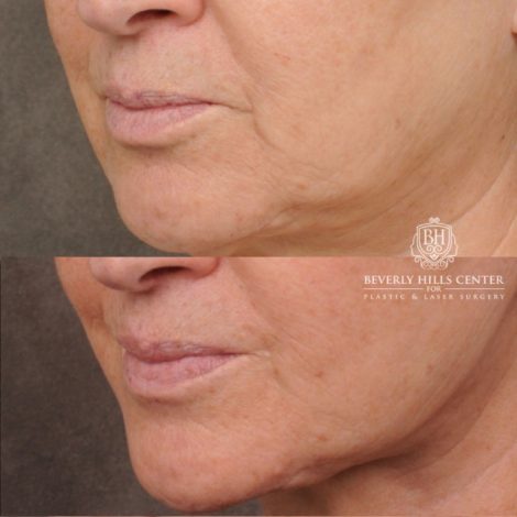 Beverly Hills Center Female Patient Before and After AuraLyft, Brow Lift, CUPID LIFT® Lip Lift, Upper Blepharoplasty