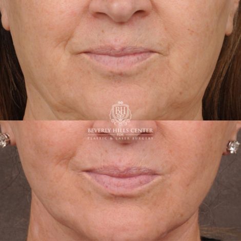 Beverly Hills Center Female Patient Before and After AuraLyft, Brow Lift, CUPID LIFT® Lip Lift, Upper Blepharoplasty