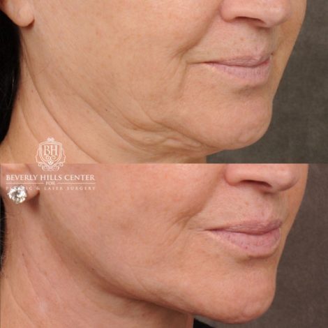 Beverly Hills Center Female Patient Before and After AuraLyft, Brow Lift, CUPID LIFT® Lip Lift, Upper Blepharoplasty