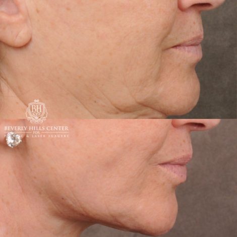 Beverly Hills Center Female Patient Before and After AuraLyft, Brow Lift, CUPID LIFT® Lip Lift, Upper Blepharoplasty