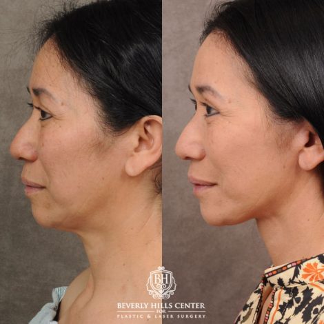 Beverly Hills Center Female Patient Before and After AuraLyft, Upper Blepharoplasty, and Brow Lift