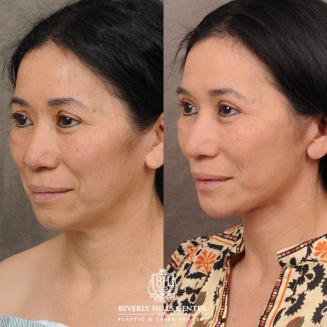 Beverly Hills Center Female Patient Before and After AuraLyft, Upper Blepharoplasty, and Brow Lift