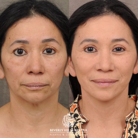 Beverly Hills Center Female Patient Before and After AuraLyft, Upper Blepharoplasty, and Brow Lift