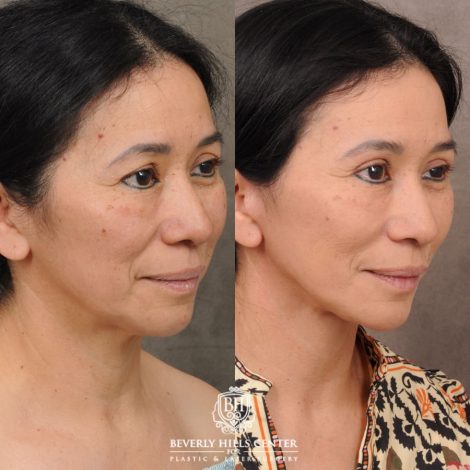 Beverly Hills Center Female Patient Before and After AuraLyft, Upper Blepharoplasty, and Brow Lift