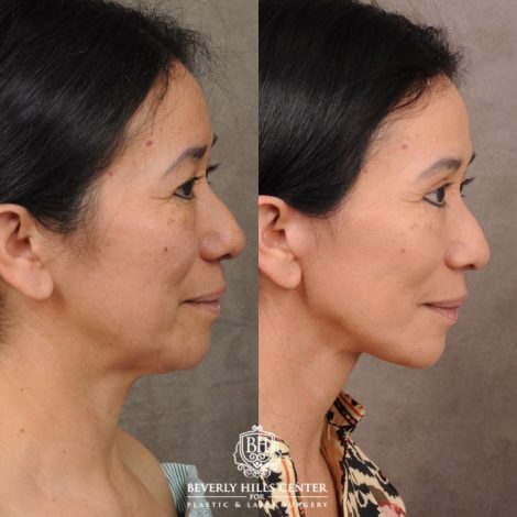 Beverly Hills Center Female Patient Before and After AuraLyft, Upper Blepharoplasty, and Brow Lift