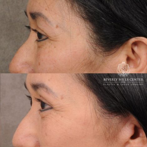 Beverly Hills Center Female Patient Before and After AuraLyft, Upper Blepharoplasty, and Brow Lift