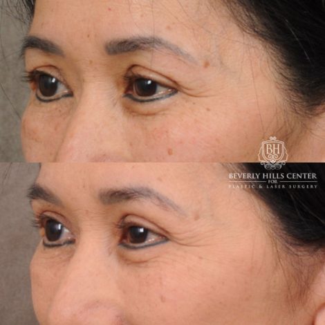 Beverly Hills Center Female Patient Before and After AuraLyft, Upper Blepharoplasty, and Brow Lift