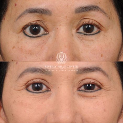 Beverly Hills Center Female Patient Before and After AuraLyft, Upper Blepharoplasty, and Brow Lift