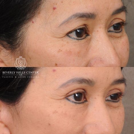 Beverly Hills Center Female Patient Before and After AuraLyft, Upper Blepharoplasty, and Brow Lift