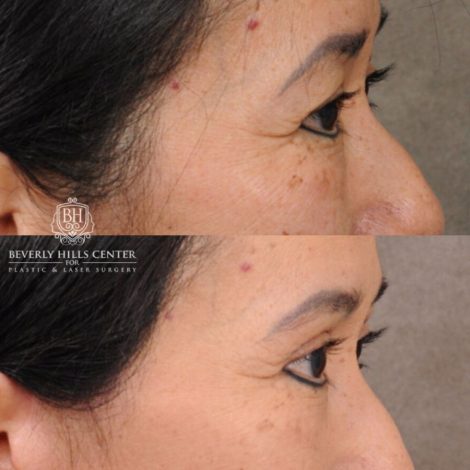 Beverly Hills Center Female Patient Before and After AuraLyft, Upper Blepharoplasty, and Brow Lift