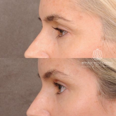 Beverly Hills Center Female Patient Before and After Brow Lift, Upper & Lower Blepharoplasty, PHAT, and Profound RF