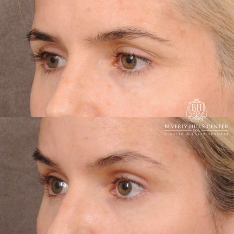 Beverly Hills Center Female Patient Before and After Brow Lift, Upper & Lower Blepharoplasty, PHAT, and Profound RF