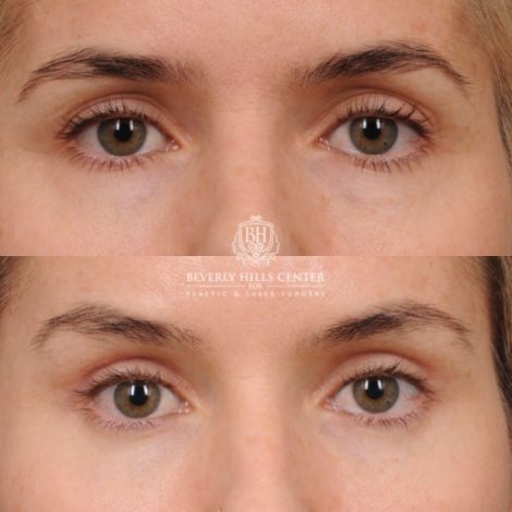 Beverly Hills Center Female Patient Before and After Brow Lift, Upper & Lower Blepharoplasty, PHAT, and Profound RF