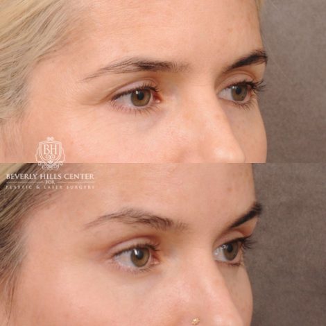 Beverly Hills Center Female Patient Before and After Brow Lift, Upper & Lower Blepharoplasty, PHAT, and Profound RF