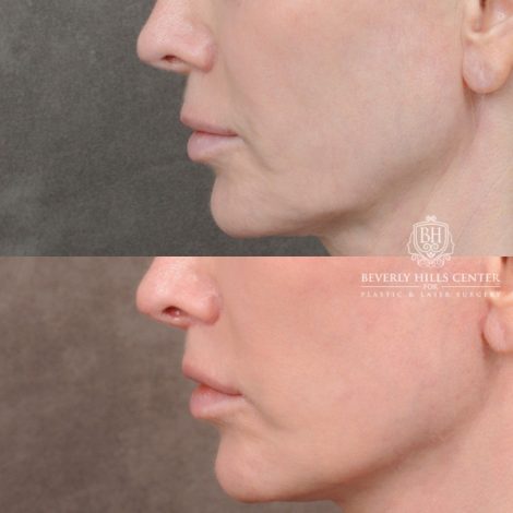 Beverly Hills Center Female Patient Before and After Comprehensive AuraLyft with CUPID LIFT® Lip Lift