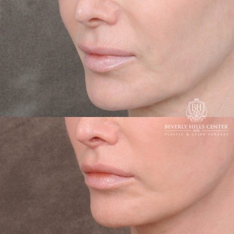 Beverly Hills Center Female Patient Before and After Comprehensive AuraLyft with CUPID LIFT® Lip Lift