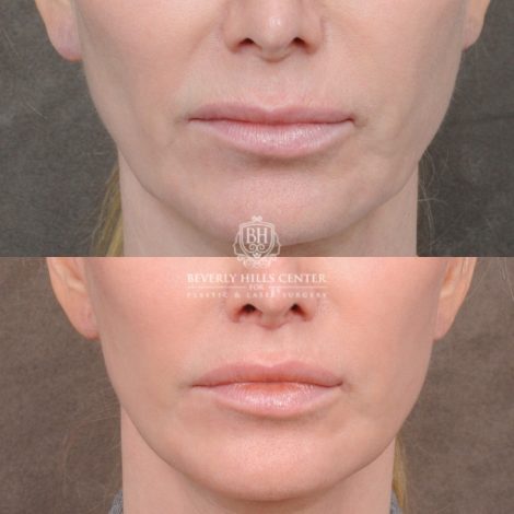 Beverly Hills Center Female Patient Before and After Comprehensive AuraLyft with CUPID LIFT® Lip Lift