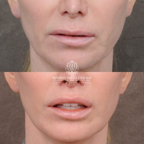 Beverly Hills Center Female Patient Before and After Comprehensive AuraLyft with CUPID LIFT® Lip Lift