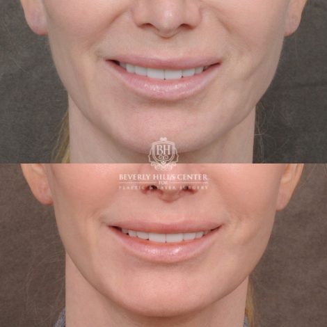 Beverly Hills Center Female Patient Before and After Comprehensive AuraLyft with CUPID LIFT® Lip Lift