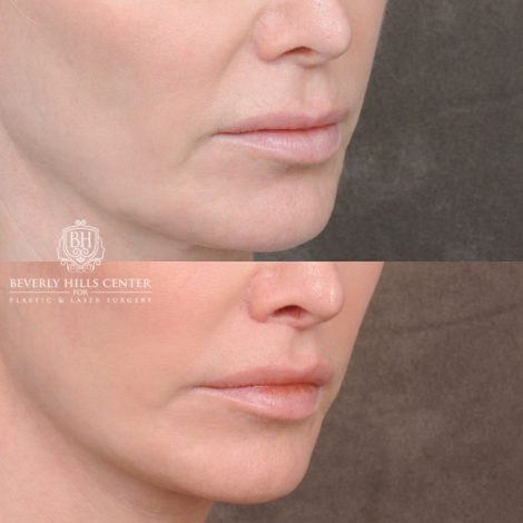 Beverly Hills Center Female Patient Before and After Comprehensive AuraLyft with CUPID LIFT® Lip Lift