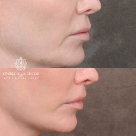 Beverly Hills Center Female Patient Before and After Comprehensive AuraLyft with CUPID LIFT® Lip Lift