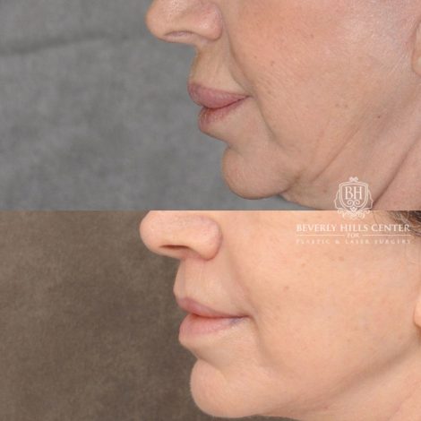 Beverly Hills Center Female Patient Before and After CUPID LIFT® Lip Lift