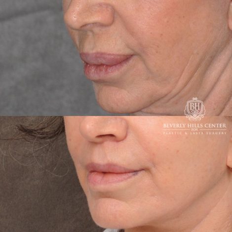 Beverly Hills Center Female Patient Before and After CUPID LIFT® Lip Lift