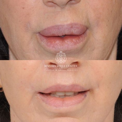 Beverly Hills Center Female Patient Before and After CUPID LIFT® Lip Lift