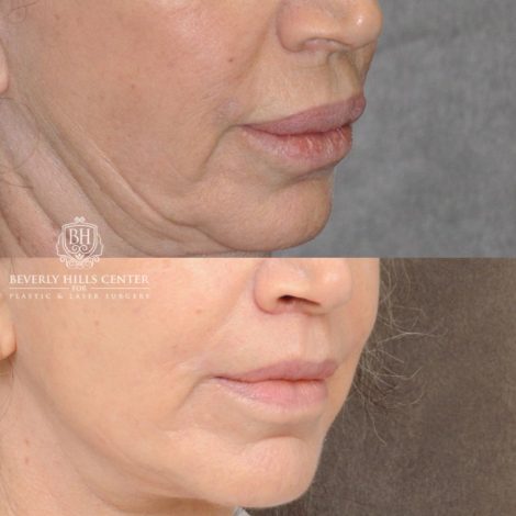 Beverly Hills Center Female Patient Before and After CUPID LIFT® Lip Lift