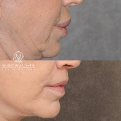 Beverly Hills Center Female Patient Before and After CUPID LIFT® Lip Lift