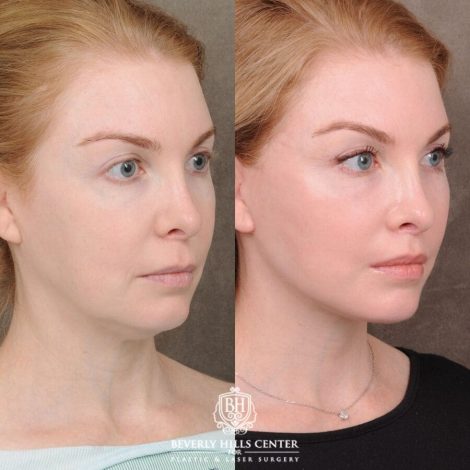 Beverly Hills Center Female Patient Before and After AuraLyft, CUPID LIFT®, Nanofat PRP