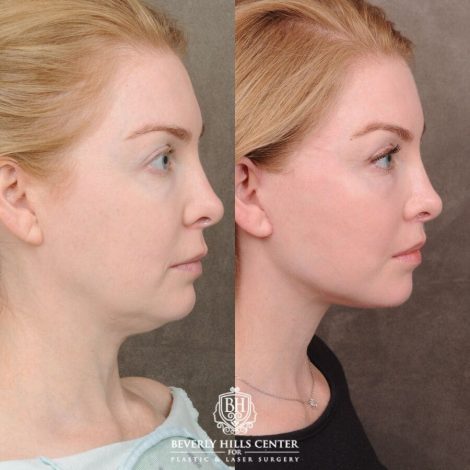 Beverly Hills Center Female Patient Before and After AuraLyft, CUPID LIFT®, Nanofat PRP